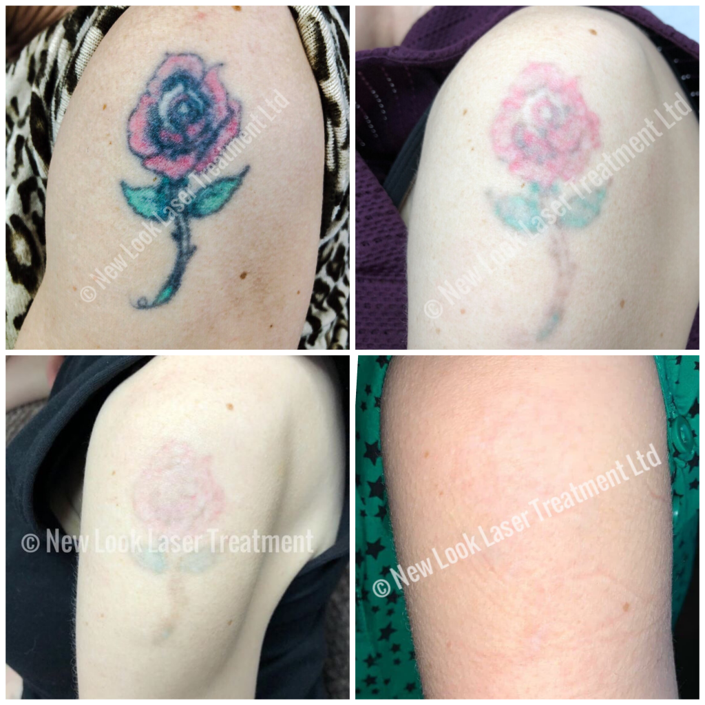 Tattoo Removal New Look Laser Treatment Ltd